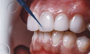 What to Expect During a Veneer Placement Procedure