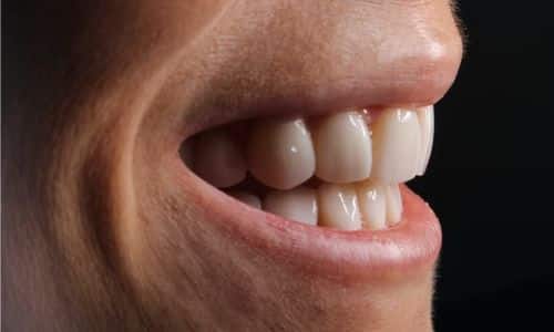 In this article, we will explore the differences between porcelain vs. composite veneers and determine which is the best option for you.