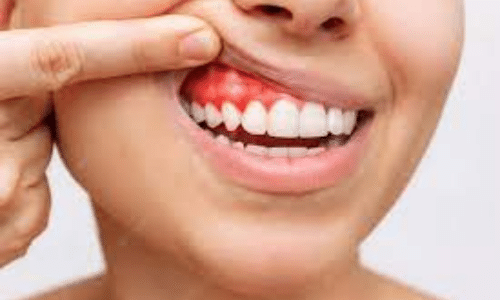 What causes bleeding gums?