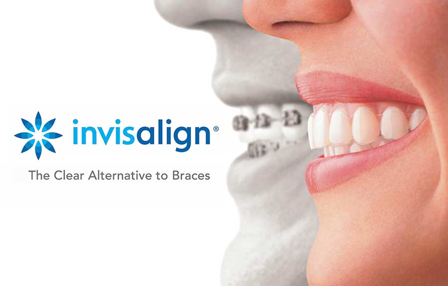 Invisalign® aligners straighten teeth. like no others