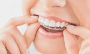 This comprehensive guide provides all the information you need about invisible braces, from how they work to the various types available and the factors to consider when deciding.