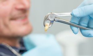 Tooth extraction myths