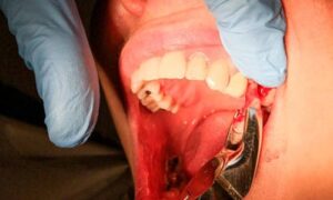 This article aims to delve deep into the world of tooth extractions in orthodontics, exploring their significance, controversies, and impact on overall dental health.