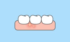 types of gum boils