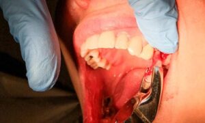 healthy tooth socket after extraction