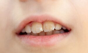 prevent enamel erosion