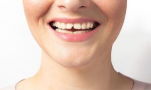 Chipped teeth