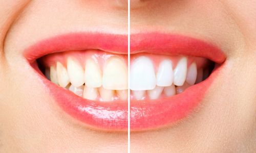teeth whitening vs. brightening